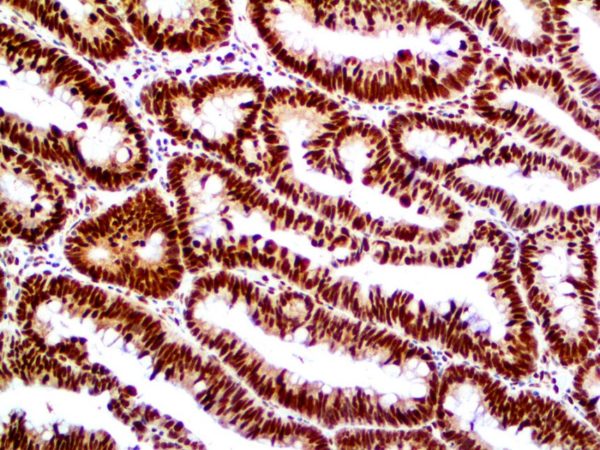 Retinoblastoma – MMab