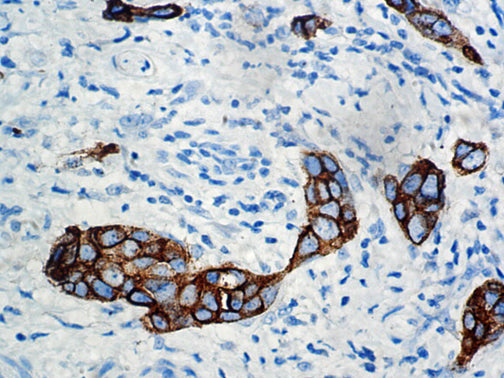 CA15-3 – MMab