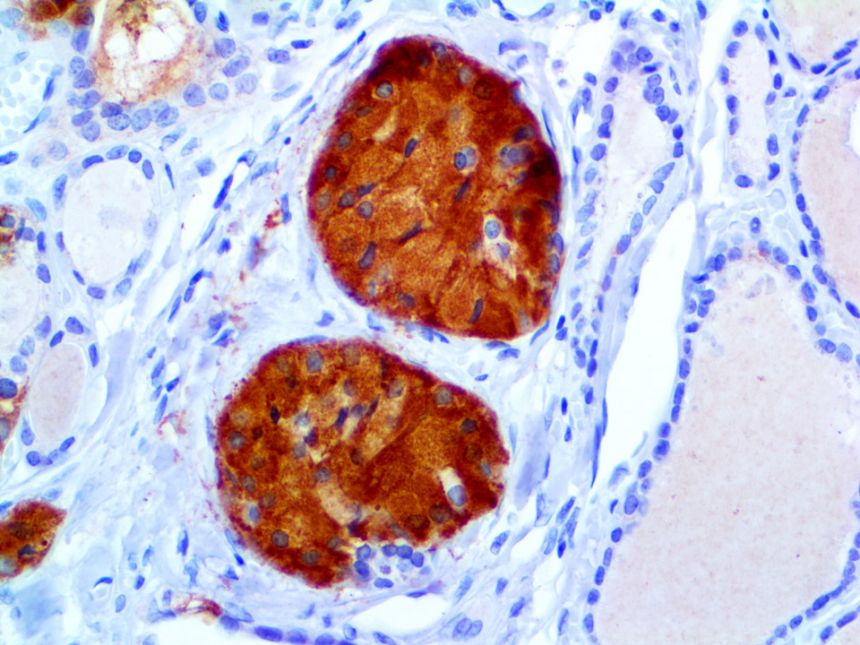 Calcitonin – RMab