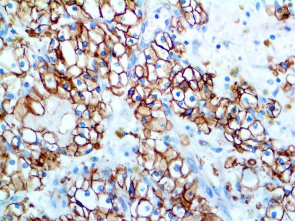 Carbonic Anhydrase 9 – RMab