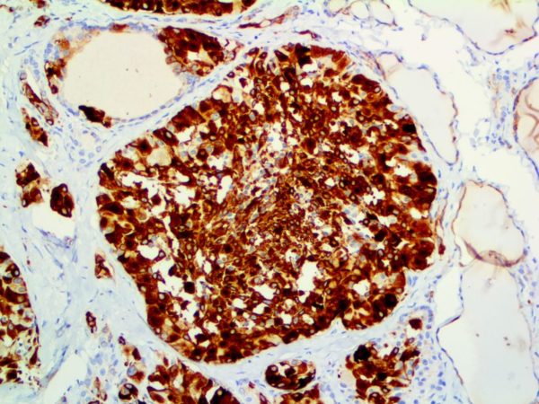 Cytokeratin 19 – MMab