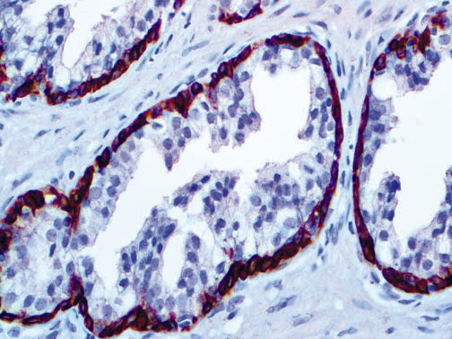 Cytokeratin HMW 34BetaE12 – MMab