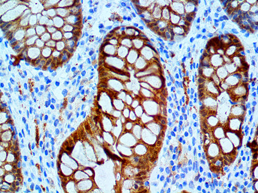 Galectin-3–MMab