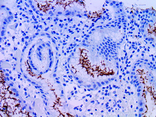 Helicobacter Pylori – RMab