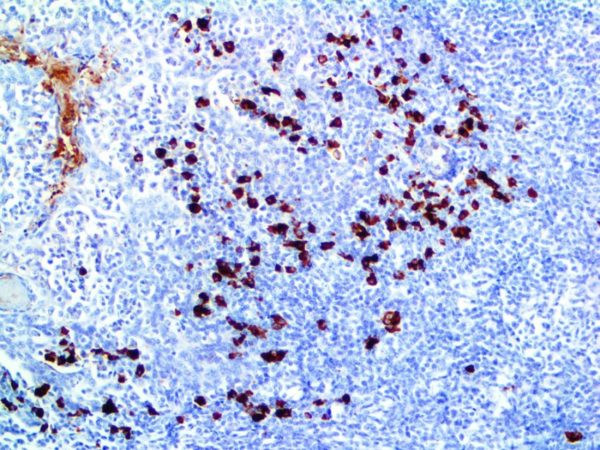 IgA – MMab