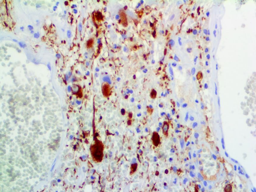 Neurofilament – MMab