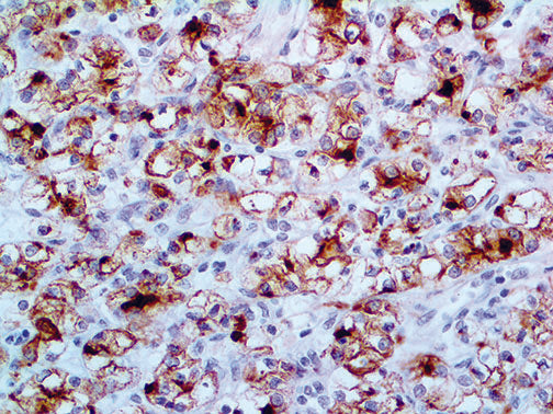 Renal Cell Carcinoma – MMab